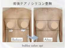 アピ(api)/症例写真【インディバ】