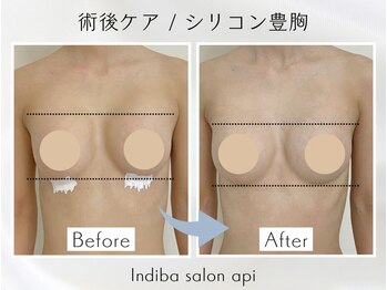 アピ(api)/症例写真【インディバ】