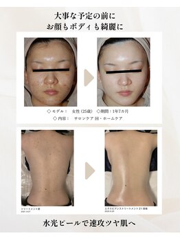 エテル(eter)の写真/【敏感肌OKの肌質改善】刺激を抑えた水光ピール◆お顔のツヤ増し＆背中ニキビ、かかとのガサガサ解消