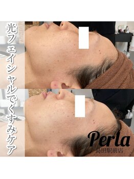 ぺルラ 島田駅前店(Perla)/光フェイシャル