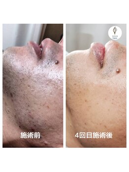 ヴォアール 名古屋店(VOIR)/ヒゲ脱毛