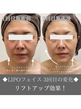 ナンバーファイブクリニカルサロン 札幌店(No.5)/BeforeAfter/リフトアップ