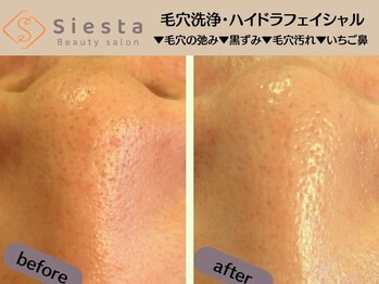 シエスタ(siesta)/毛穴洗浄ブーム到来