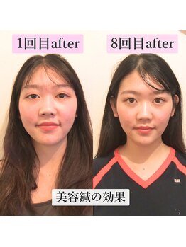 ゲンキ鍼灸整骨院 かどの(Genki鍼灸整骨院)/美容鍼