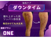 ミスエス(Miss es)/ダウンタイムケア