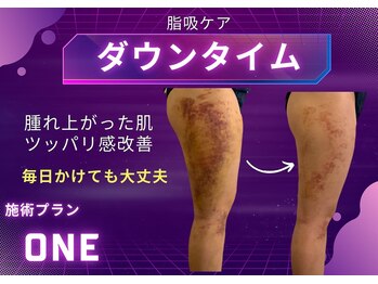 ミスエス(Miss es)/ダウンタイムケア