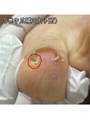 【巻き爪補正(1ヶ所)】