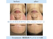 リテルナ(Re.terna)/肌質改善フェイシャル