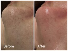 ケー(K)/毛穴の引き締めまでさせてします