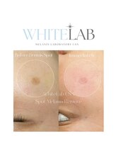 ツキ(TSUKI)/シミケア