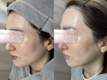 モガナ(mogana)/40代・シミケアサブスクプラン