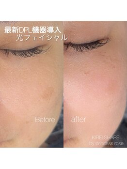 プリンセスローズ 焼津店(Princess Rose)/光フェイシャル