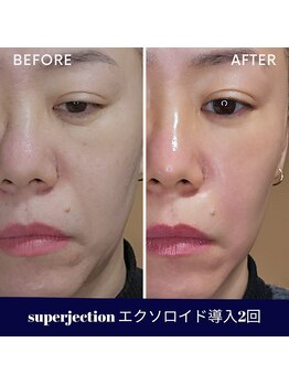 水光ピールスキン　池袋の写真/東京池袋で叶える理想の肌質改善！スーパージェクションでほうれい線のケアを☆
