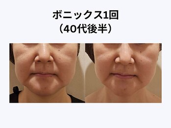 アユアラングレース/40歳後半・1回/むくみ解消