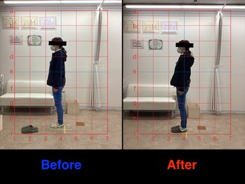 整体院 仁(JIN)/#内側上顆炎#外側上顆炎#ひじ痛