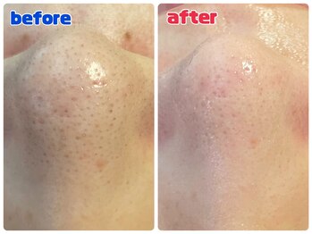 リジュベ 古河店(Rejuve)/毛穴エクストラクション