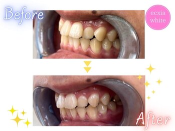 エクシアホワイトニング 原宿店/ホワイトニングビフォーアフター