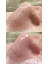 クレヴィー(Creviy)/韓国式3D毛穴洗浄(初回1回目)