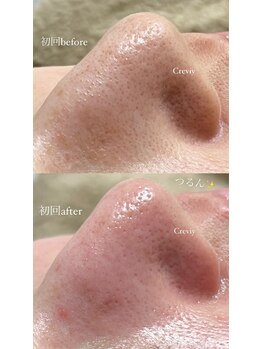 クレヴィー(Creviy)/韓国式3D毛穴洗浄(初回1回目)