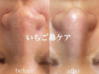 ネオリー(neorii)/毛穴洗浄♪