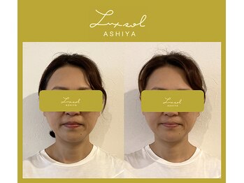 ルク ソル(Luxsol)/骨格調整でお顔を引き上げます！