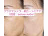 ★年末限定★【美白シミケア&艶肌】プラズマ&フォト 60分¥14800→8000