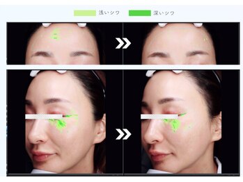 ステラ(STELLA)/1回で30%の小シワ改善!