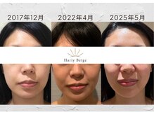 ハリーベージュ(Hariy Beige)の雰囲気（【月1美容鍼】8年の経過完全個室／美容鍼//鍼灸/エイジングケア）