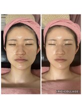 BBC 田園調布/スピダイヤコース１回の施術効果