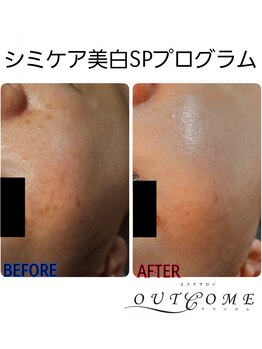 アウトカム(OUTCOME)/シミケア美肌SPプログラム