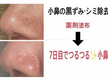 ジブラ(GEBRA)の雰囲気(毛穴の黒ずみまで除去)