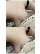 ヘアーメイク デビュー(Hair Make Debut)/首後ろ（えりあし）脱毛