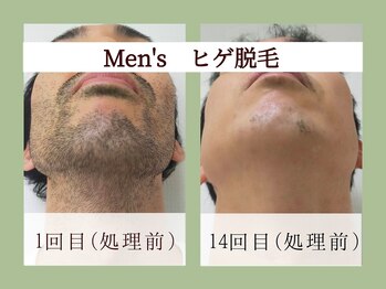 ラーナ(Lana)/脱毛