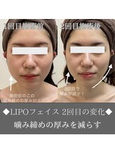 ナンバーファイブクリニカルサロン 札幌店(No.5)/BeforeAfter/エラ張り改善