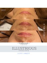 フルアナ(Hu ruana)/【シミケア】