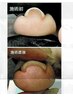 巻き爪ケア