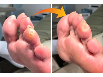 ハラリエ(Hararie)/痛いうおのめはガマンしないで！