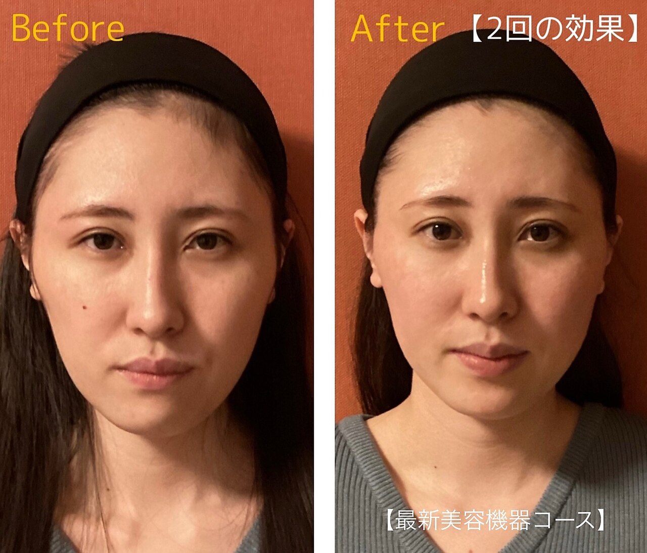 まる様専用】 効果はハッキリ分かりますリフトアップ超音波美顔器