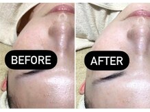 ファロンビューティー(fallon beauty)/フェイシャル Wax脱毛