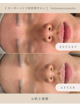 ベベ 表参道(bebe)/敏感肌の方もお任せください