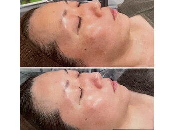 ブルーム(BLOOM)/フェイシャルエステ