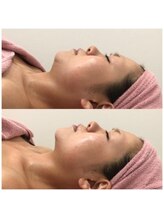 エミット(emit.)/二重あご改善