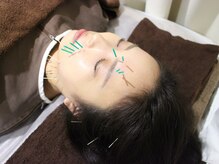 美リレア/大人気☆美容鍼