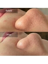 ハートランド(HEARTLAND)/毛穴悩みとなよならしたい！