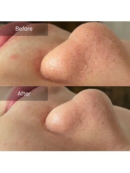 ハートランド(HEARTLAND)/毛穴悩みとなよならしたい!