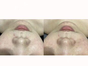 ルボン(RUBON)/ 毛穴レス肌