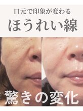 Nビューティー/最新RFサーモシェイプオーパス