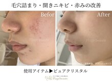 シュシュ 岸和田(chouchou)/肌質改善クリスタルハーブ