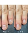 自爪育成3ヶ月コース