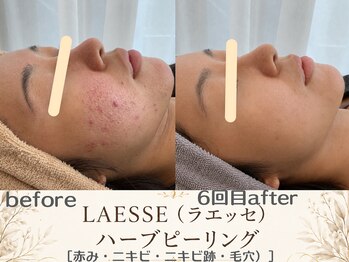 エスポワール(espoir)/皮脂が多いニキビ肌改善